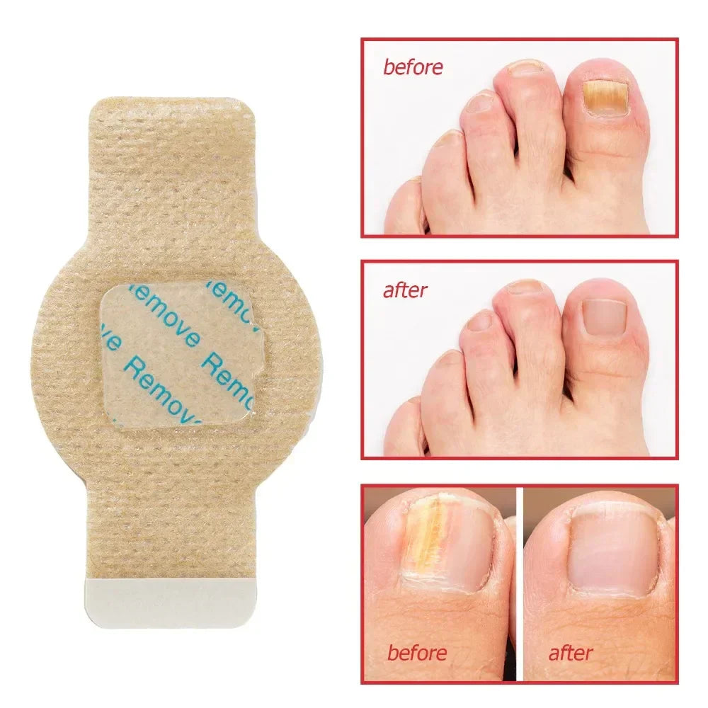 Fungal Nail Patches 21 Pcs