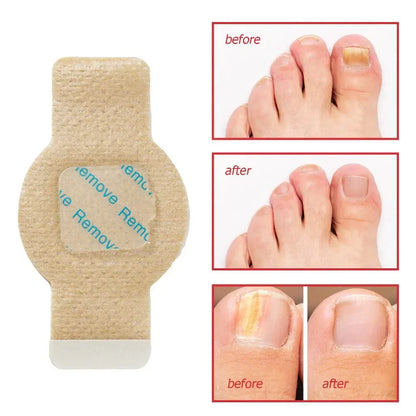 Fungal Nail Patches 21 Pcs